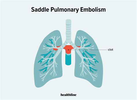 Saddle Pulmonary Embolism คืออะไร Khao Ban Muang