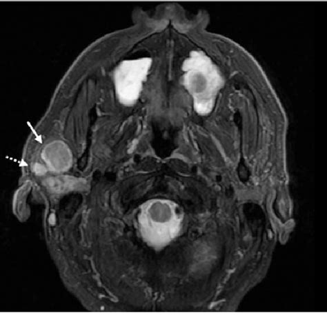 Ultrasound Guided Ethanol Sclerotherapy For Multifocal Unilateral