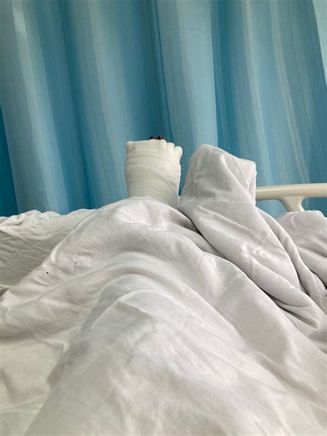 Surviving An Open Compound Fracture Through An Unmistakable Miracle