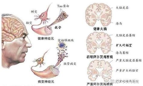 老年痴呆症有救了？首款阿尔茨海默病新药明年初申请上市 天下网商记者 贡晓丽老年痴呆症可能有救了！美国生物技术公司百健（biogen）和日本制药