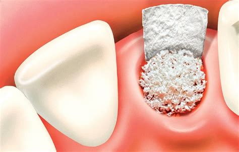 Dental Bone Graft: Materials, Cost and Procedure