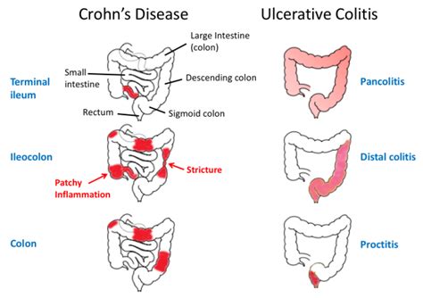 inflammatoryboweldiseaseibd tusom pharmwiki