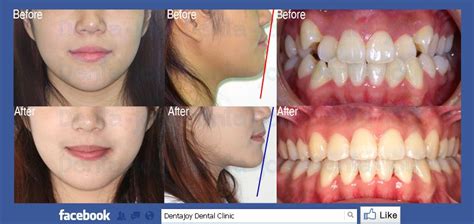 4 teeth extraction for braces before and after