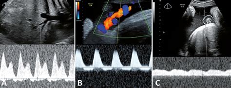 A Doppler Ductus Venoso Onda A Reversa B Doppler De Arteria