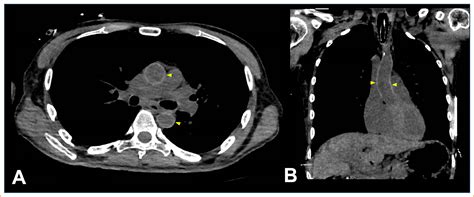 Diagnosing Anemia With Chest Ct Scan The Aortic Ring Sign The