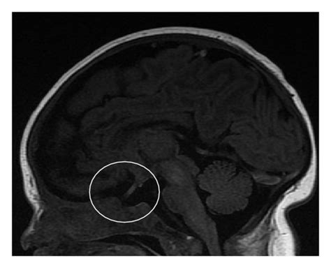 A Mri Sagittal View Demonstrates No Evidence Of The Sella Turcica