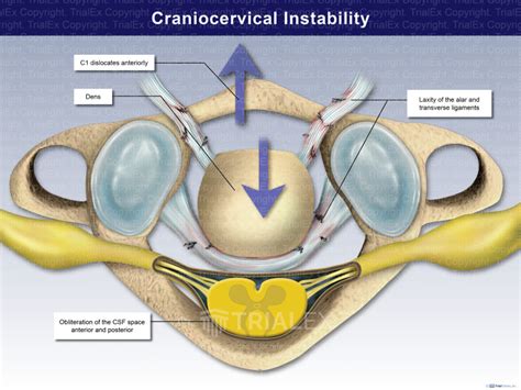 Craniocervical Instability Trialexhibits Inc