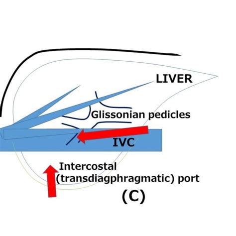 Schema Of Open Liver Resection A Usual Laparoscopic Liver Resection