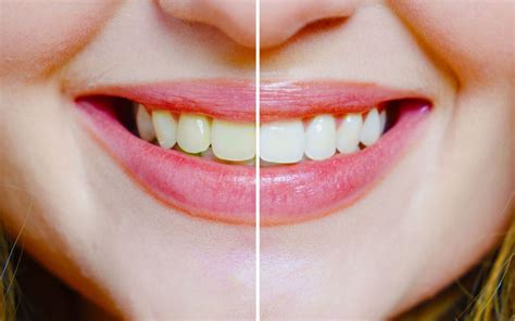 Professional In Office Vs At Home Teeth Whitening What S Best