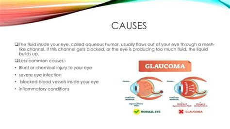 Glaucoma Final Pptx