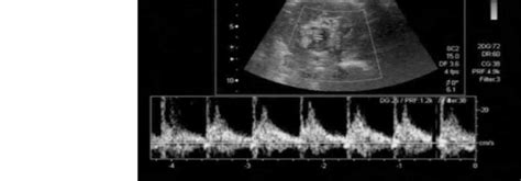 Transverse scan of the left kidney showing a hypoechoic mass with... | Download Scientific Diagram