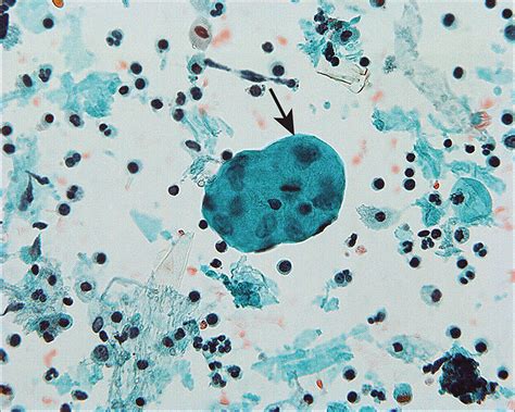 Diagnostic Cytopathology Of Peritoneal Washings Cytojournal