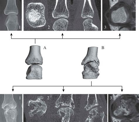 Two Examples Of Metacarpophalangeal Mcp Joints Example A An Mcp Download Scientific Diagram