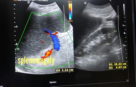 Ultrasound imaging: Nodular-cirrhosis-liver