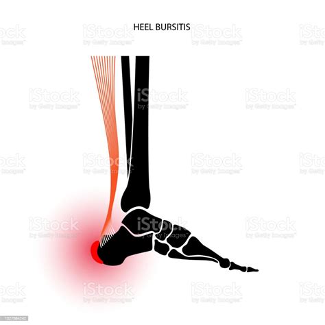 Ilustración de Concepto De Inflamación De La Bursitis y más Vectores