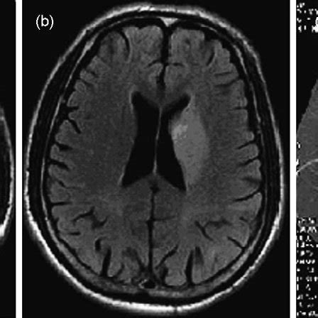 A Year Old Man With Cerebrovascular Neurosyphilis Who Had Right