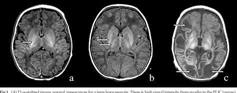 Figure 1 From Mild Hypothermia And The Distribution Of Cerebral Lesions In Neonates With Hypoxic