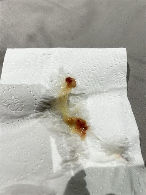 F27 Coughing Up Blood In Phlegm And Ear Infection Rdiagnoseme