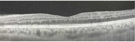 Swept Source Ss Oct Imaging Of The Left Eye Horizontal Scans Are