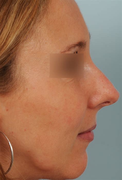 Photos de rhinoplastie avec bosse sur le nez avant et après