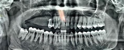 Pre Op Orthopantomograph Shows An Ill Defined Homogenous Radiolucency