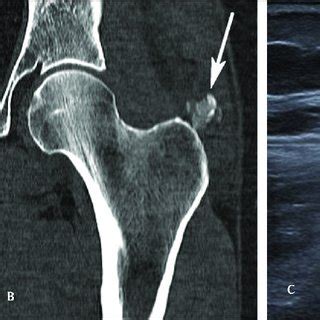 Pdf A Case Of Bilateral Acute Calcific Tendinitis Of The Gluteus