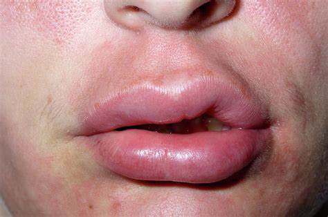 Swollen Lip Photograph By Dr P Marazziscience Photo Library