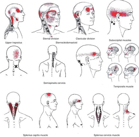 Suboccipital Muscles Trigger Points