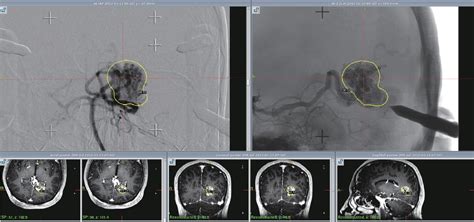 Figure 3 From A Review Of Cerebral Arteriovenous Malformations And Treatment With Stereotactic