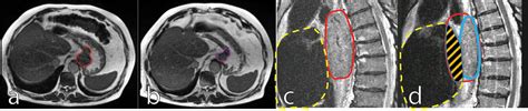 Frontiers Review Of MR Guided Radiotherapy For Esophageal Cancer