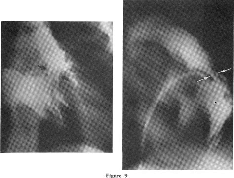 Figure 1 From Angiographic Appearance Of Idiopathic Hypertrophic