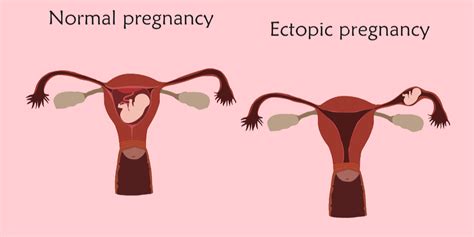 Ectopic Pregnancy Symptoms Blog Pregnancysymptoms