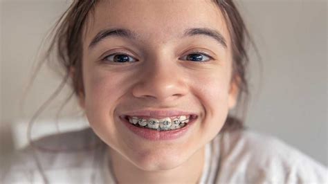 2024 Traditional Braces: Breaking Down Costs, Types, And Pain