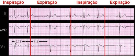 Cardiologia - ECG - Arritmias Cardíacas - Bradicardia Sinusal, Arritmia Sinusal, Parada Sinusal ...