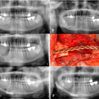 Surgical treatment of medication-related osteonecrosis of the jaw in ...