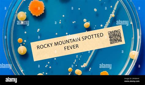 Rocky Mountain spotted fever - Bacterial infection transmitted by ticks ...