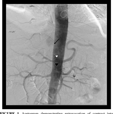 Figure From Successful Management Of Aorto Conduit Fistula After