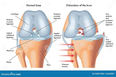 Dislocation of knee stock vector. Illustration of dislocated - 228057288