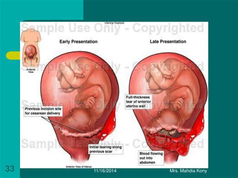 Ppt Postpartum Hemorrhage Powerpoint Presentation Free Download Id