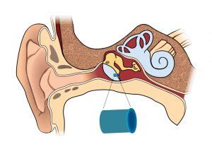 Ear Tubes - Mississippi Ear Nose & Throat Surgical Associates