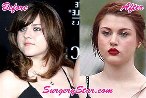 Frances Bean Cobain Plastic Surgery Inspiring Your Life