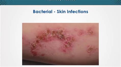 Bacterial Skin Infections Dermatology Edurx Youtube