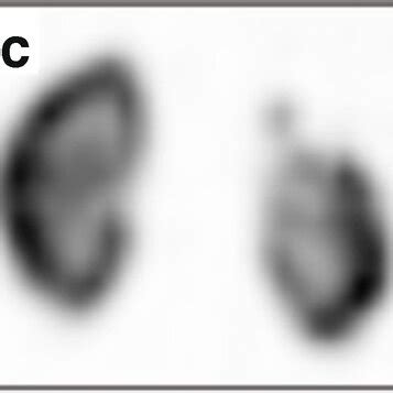 Comparison Of Planar And Single Photon Emission Computed Tomography