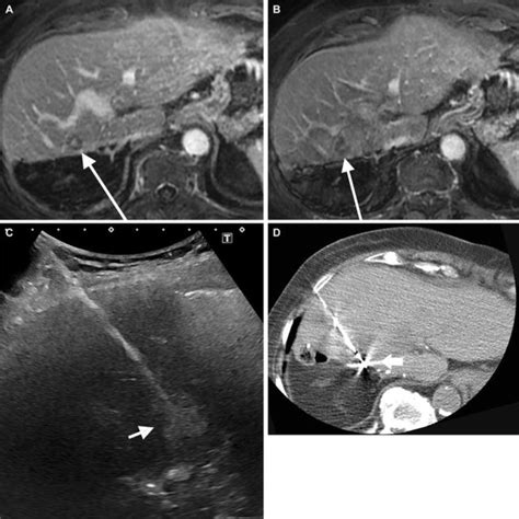 Percutaneous Microwave Ablation Of 1 5 Cm Hcc With Complete Treatment Download Scientific