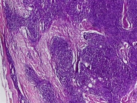 Ab Thymoma Showing Nodular Growth Pattern With Diffuse Areas Hande X40 Download Scientific