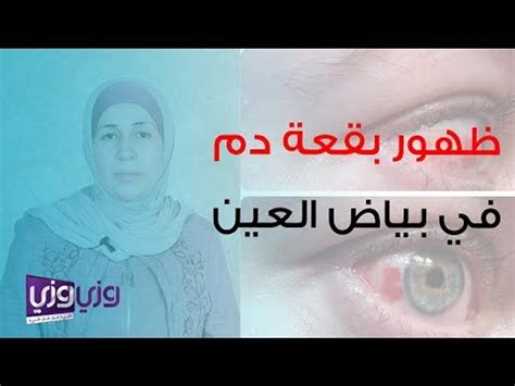 أسباب ظهور بقعة دم في بياض العين فيديو Dailymotion