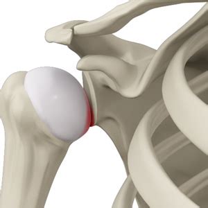 Shoulder Subluxation Virginia Beach, VA | Shoulder Dislocation ...