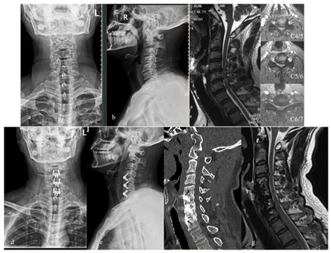 Brain Sciences Free Full Text Is The Zero P Spacer Suitable For 3 Level Anterior Cervical