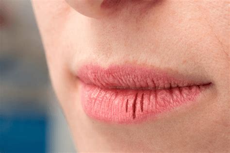 What Are Dry Lips A Symptom Of Lipstutorial Org