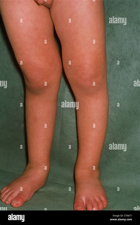 Rickets child hi-res stock photography and images - Alamy